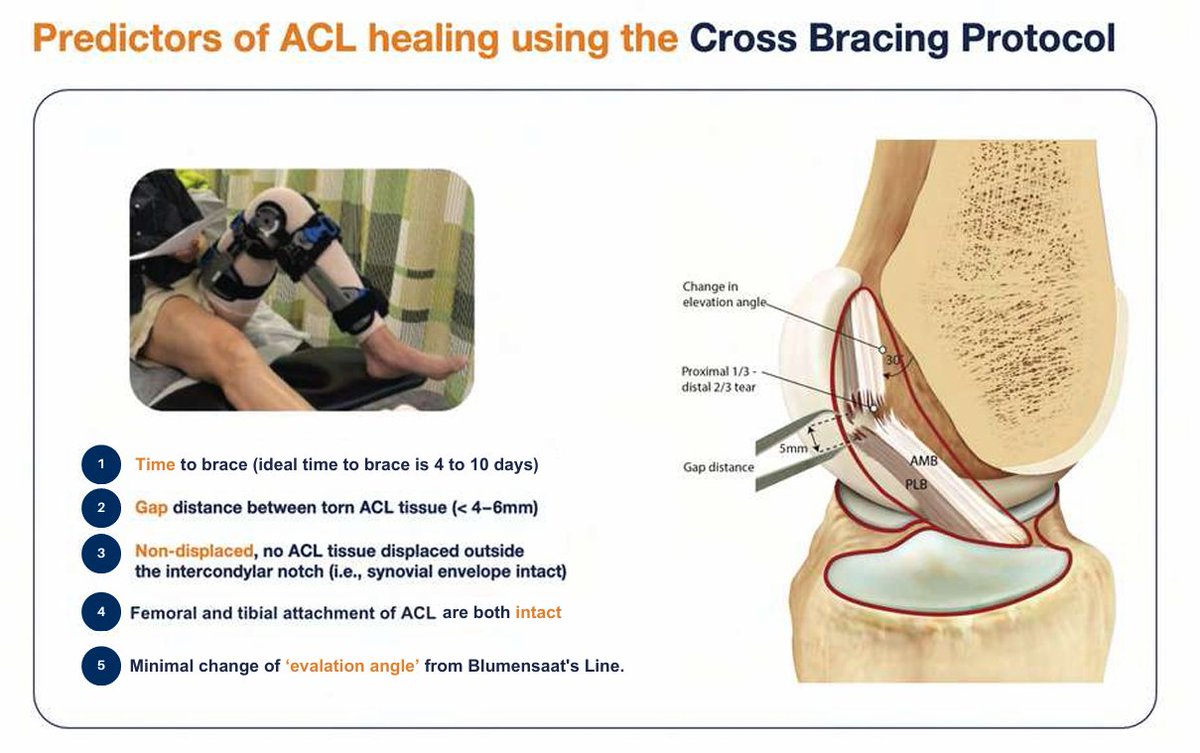 SportsMedReview's tweet photo. The cross bracing protocol for ACL injuries emphasizes early controlled range of motion and progressive loading to promote ligament healing without immediate surgery. By combining structured rehabilitation with targeted bracing, it offers select patients a nonoperative pathway to restore stability and function.

Read: https://t.co/fvost3A3aW

#SportsMedicine #Orthopedics #PhysicalTherapy #AthleticTraining #Rehab #InjuryPrevention #Physio #SportsInjury #SportsRehab #PhysioTherapy #Meded #ATC #FOAMed