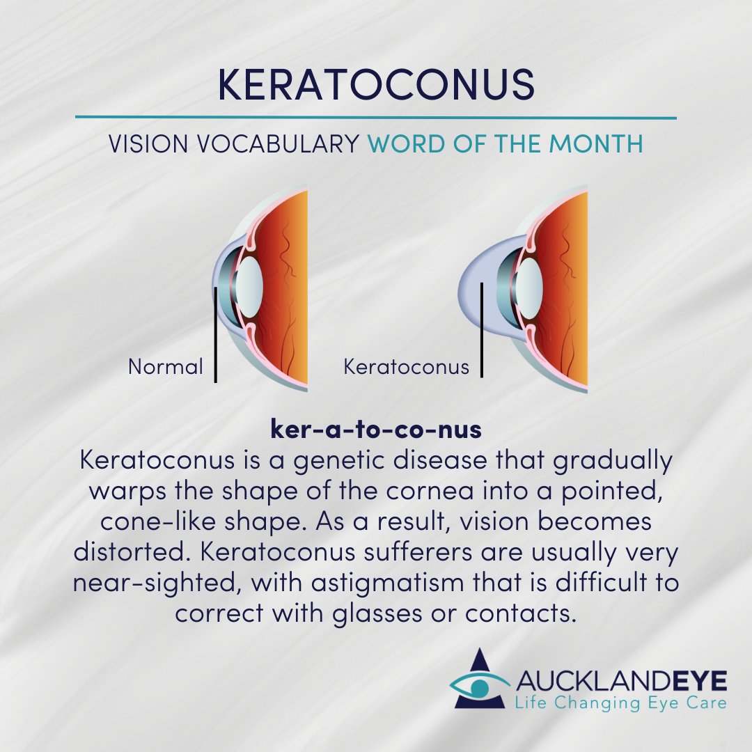 Akl_Eye's tweet image. This month in Vision Vocabulary, we’re exploring ‘Keratoconus’, a condition which makes the cornea slightly cone shaped.

#EyeHealth #HealthyVision #AucklandEye #LoveYourEyes #Keratoconus #LifeChangingEyeCare