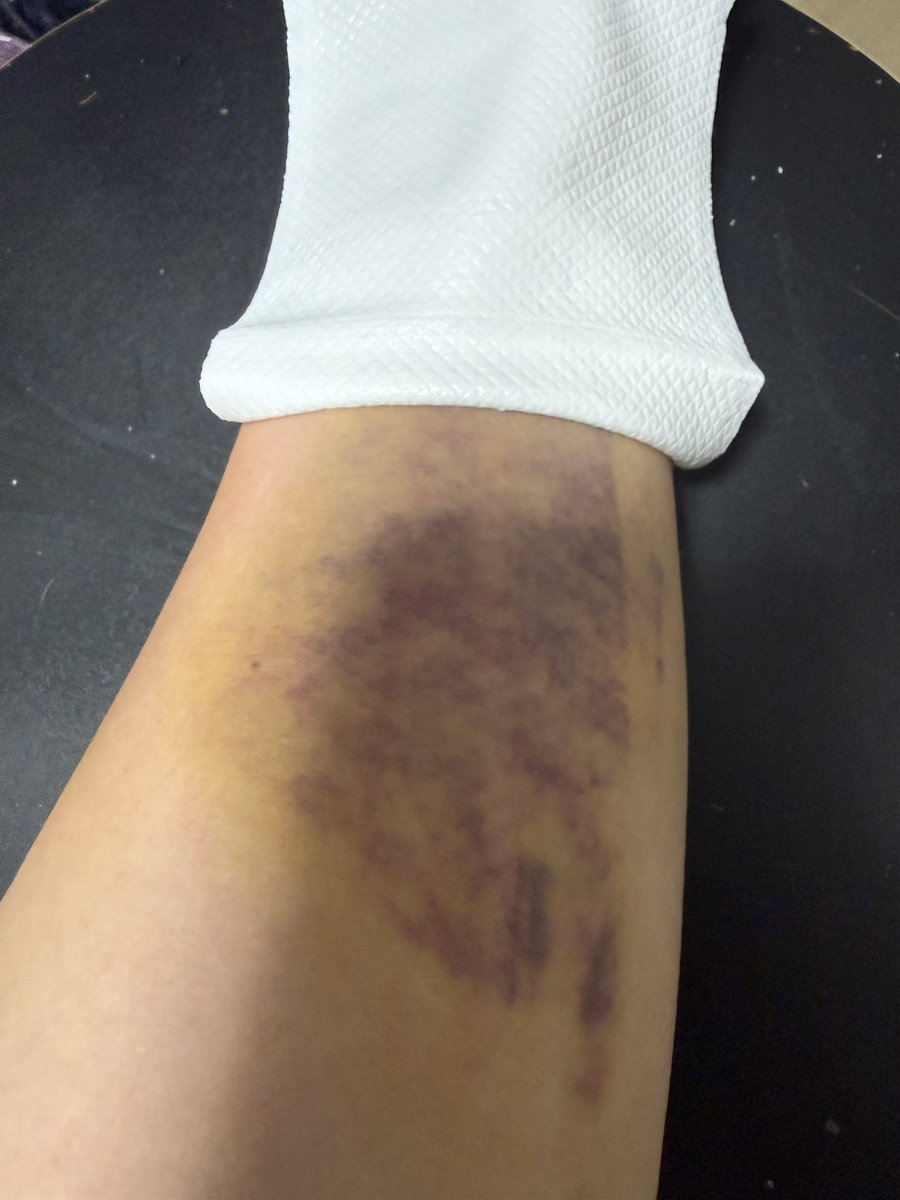 MinetoOdahara's tweet image. 肉離れが治りませんなー。鈍い痛みが継続してまして、何もヤル気が起こらないという…。😑
無理をしたツケを支払っておりますので、しばらくゴルフ⛳️はお休みでしょう。🫨
#ゴルフ #肉離れ