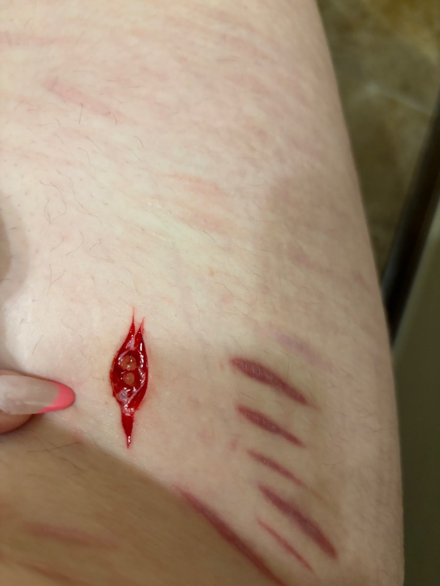 Deadsuculant's tweet photo. GUYS OMG I HIT BEANS??? I relapsed bc family but wow it looks so gross I hate it but I’m actually so impressed with myself 🌝🌝 BUT on a different note how do I do aftercare 😭 I don’t rlly wanna lose my leg https://t.co/4OND1usQdS