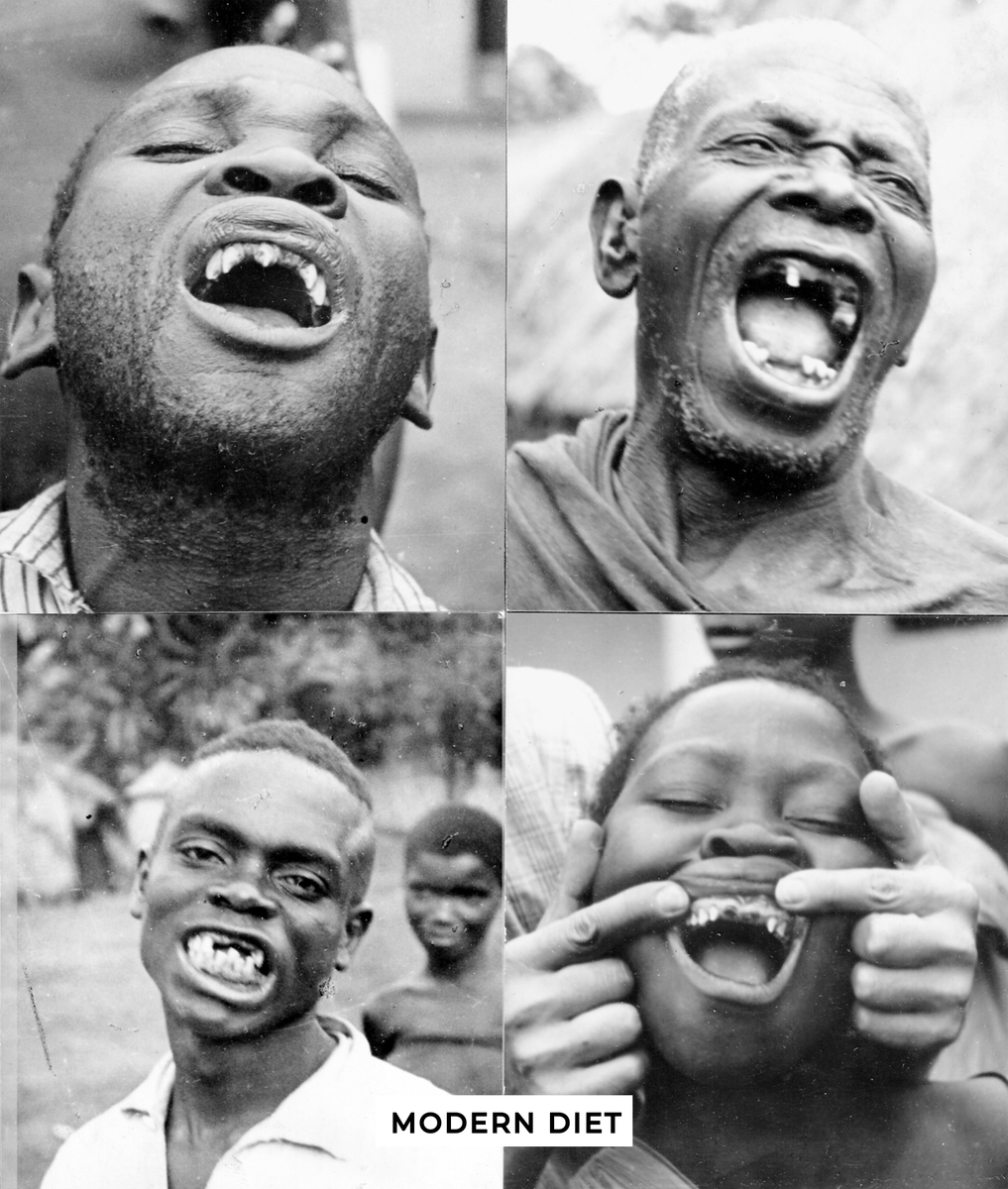 WestonAPrice's tweet photo. A picture really is worth a thousand words. In the summer of 1935, Dr. Weston A. Price took photos of African men on a traditional diet, as well as those who had started to eat a so-called modern diet, and then the next generation of Africans who ate a modern diet. Dr. Price wrote of those on a traditional diet: "Note the breadth of the dental arches and the finely proportioned features. Their bodies are as well built as their heads. Exceedingly few teeth have been attacked by dental caries while on their native foods." Compare that to the second generation on a modern diet. Notice how narrow their faces had become? Please read "How The Teeth Tell The Tale" to learn more: https://t.co/sfBVB6FDsb

Photos courtesy of Ancestral Nutrition Foundation @ANF1952