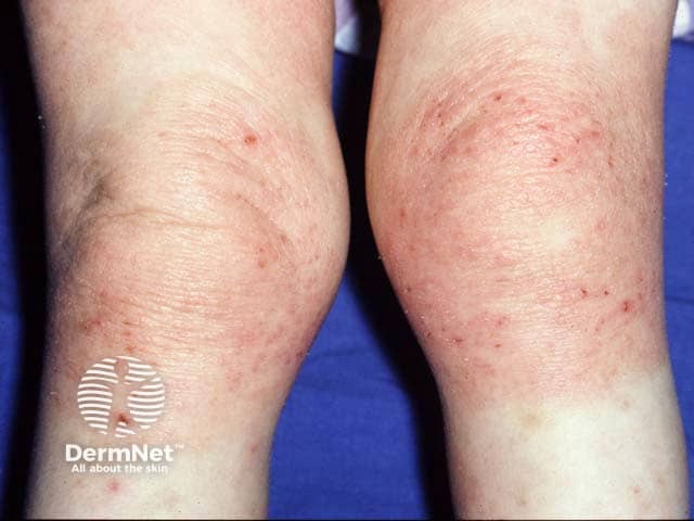 SkinofColorcomm's tweet photo. Happy Monday Mystery!

What is the root cause of the condition seen below?

A) Contact with caustic chemicals
B) FLG (filaggrin) gene mutation
C) Fungal infection (tinea corporis)
D) Vitamin D deficiency

#skinofcolorcomm #dermatology https://t.co/2u2zvZbiGl