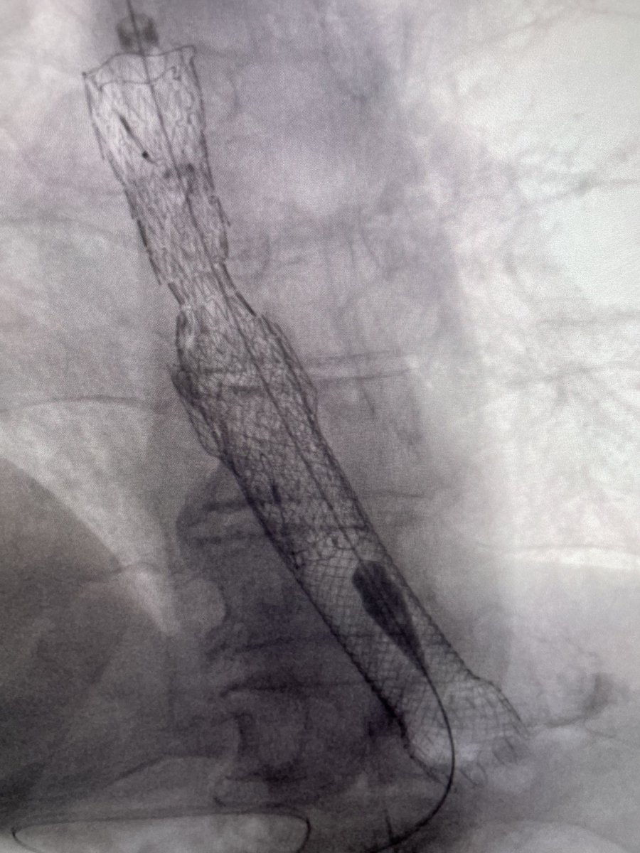 DouglasAdlerMD's tweet image. Esophageal stent placed inside old esophageal stent. Old stent had proximal tumor overgrowth. #gitwitter #surgery #medicine