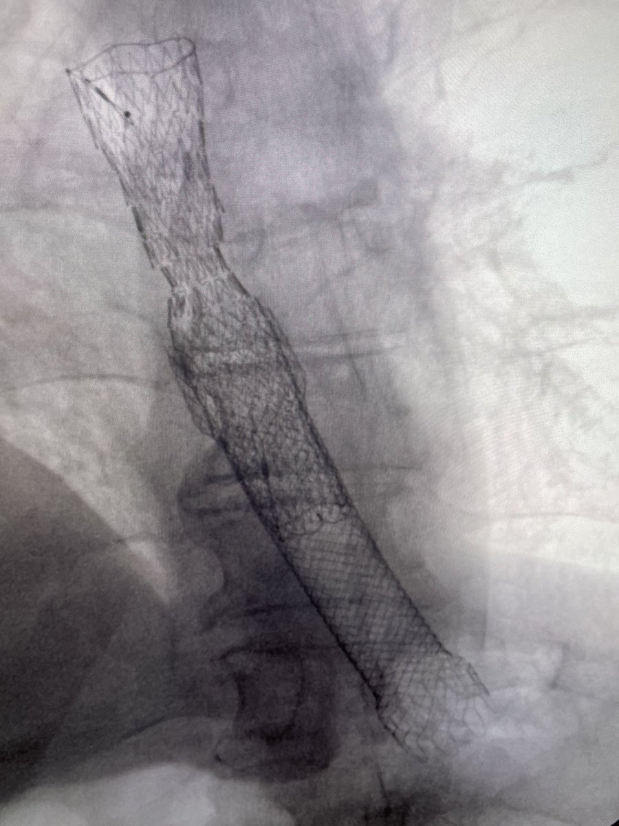 DouglasAdlerMD's tweet image. Esophageal stent placed inside old esophageal stent. Old stent had proximal tumor overgrowth. #gitwitter #surgery #medicine