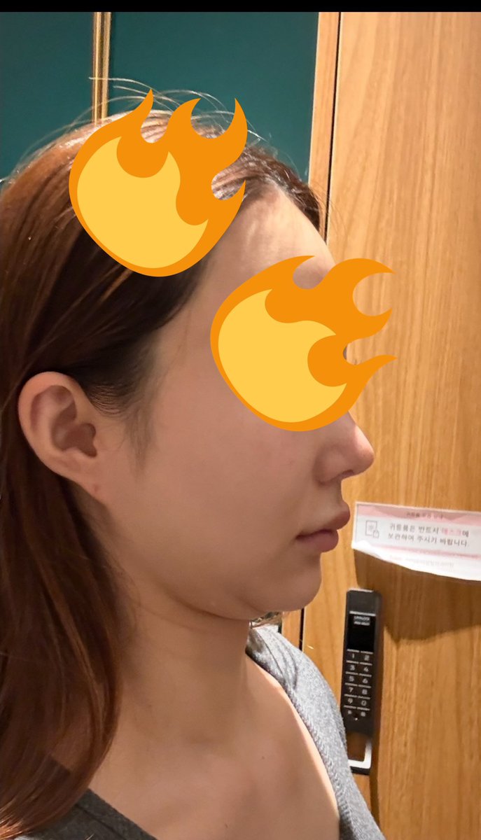 mayuaki1020's tweet photo. @ilumipsjp 
ペリカン半年目☺️
二重アゴや口横のもたつきはほぼ気にならなくなって、フェイスラインがかなり完成してきた✨
正面より横顔の変化がいちばん分かりやすい☺️
写真撮ったときのスッキリ感が全然違う📸✨
改めて、やって良かったなって思う☺️💕
同じ悩みある人の参考になれば嬉しいです https://t.co/5JzBgPmDGN