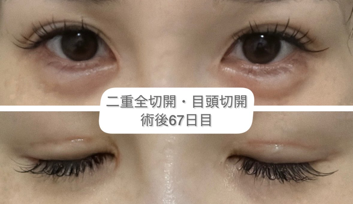 n17ph's tweet photo. 二重全切開・目頭切開DT67日目✨
整形後初のマツエク👀🎀
目がしっかり開くようになったから目に合わせてマツエクもいつもと違う長さ太さカールにした🪞
そして涙袋もアプデ🤣️🩵
徐々に切開ラインも落ち着いてきてる😳！！
 #二重全切開  #二重整形  #目頭切開 
 #二重DT https://t.co/7Vr2kh74Sg