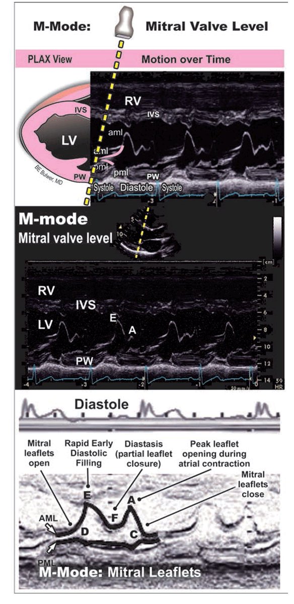TrackYourHeart's tweet image. Normal M-mode echocardiography in the parasternal long-axis (PLAX) view at the mitral valve level provides a high–temporal resolution assessment of mitral leaflet motion and left ventricular filling dynamics.

The characteristic cyclical pattern of the mitral valve reflects