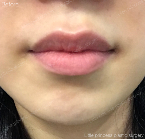 lpps_jp's tweet photo. スタッフの丁寧な対応と院長の施術にご満足いただけたとのこと、本当にありがとうございます🙏😊

オリニコンジュ美容整形外科💖

LINE相談=@793jjgaa

#オリンコンジュ整形外科 #唇フィラー #リップフィラー #渡韓 #韓国整形 #口角ボトックス #フィラー #唇ヒアルロン酸 #唇ヒアル #ヒアルロン酸 https://t.co/mNm5IspV2i