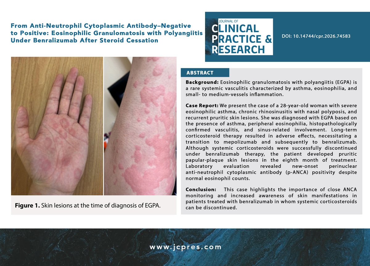 JClinPractRes's tweet photo. From Anti-Neutrophil Cytoplasmic Antibody–Negative  to Positive: Eosinophilic Granulomatosis with  Polyangiitis Under Benralizumab After Steroid Cessation

https://t.co/VSI9pPkwiX

#erciyesüniversitesi #erciyestıp #JClinPractRes #FOAMed #FOAM #MedEducation #medicaljournal https://t.co/x5vQrPuHCo