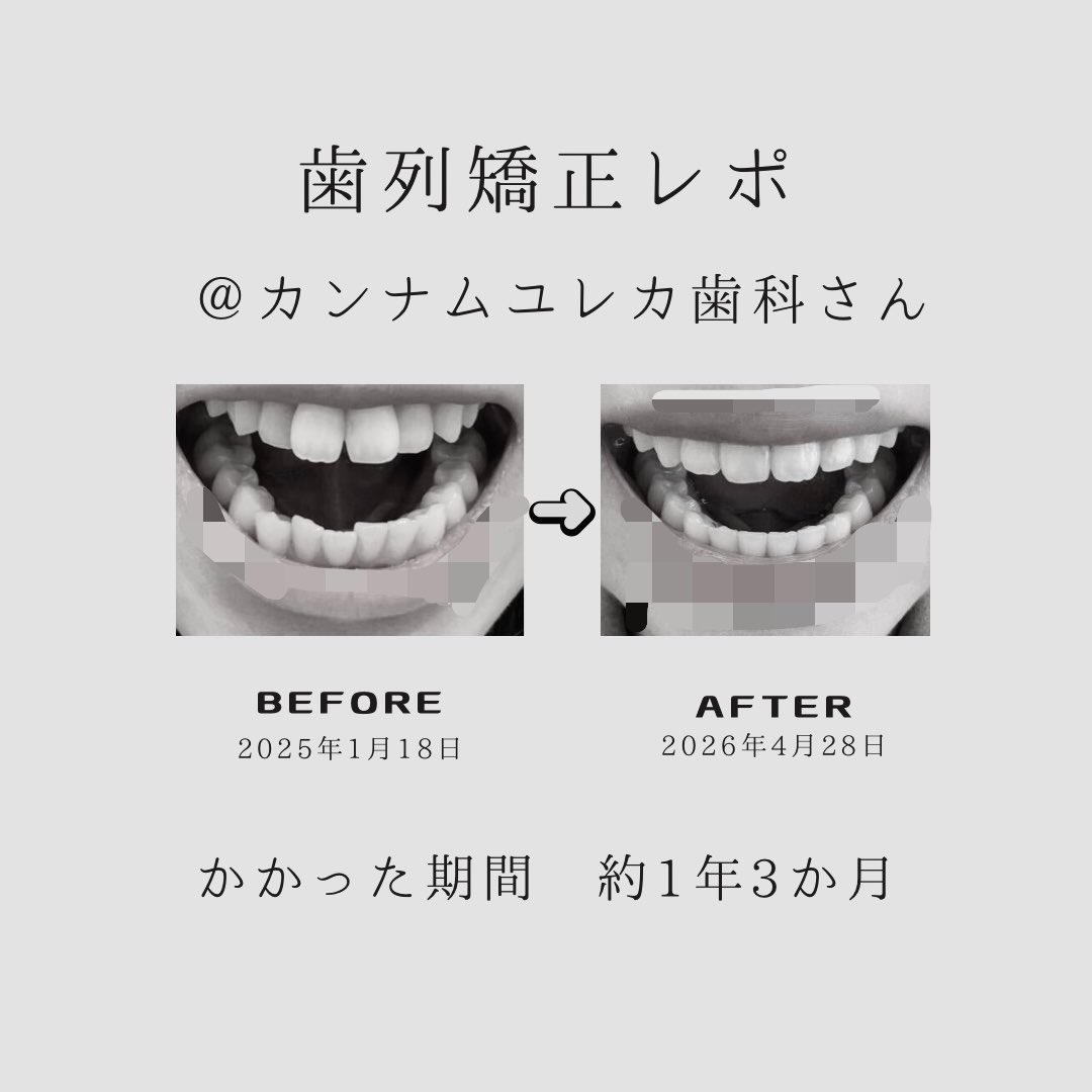 nymnyu's tweet photo. 韓国でしてた #歯列矯�� が終わりました🦷✨
口元出てるのが気になって始めたけど、約1年3ヶ月で歯並び綺麗になって、口元もちゃんと引っ込んだ🥹
笑う時に出っ歯気にしなくて良くなったし、歯ブラシもしやすくなった🪥
噛み合わせが良くなったのも虫歯対策に🙆🏻

#韓国歯列矯正 #カンナムユレカ歯科 https://t.co/FDhEBpetnu