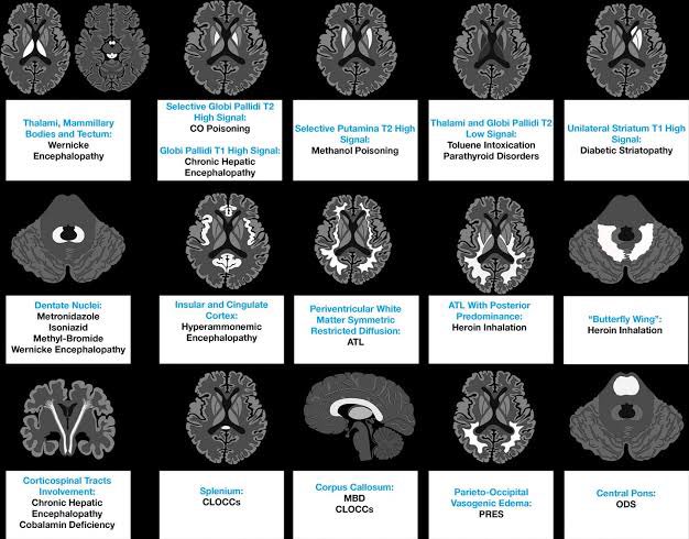 DrAyubaD's tweet photo. Toxic and metabolic brain disorders on FLAIR MRI : 

A Cheat code ; 

Deserves a billion views 😉

Again ; Cheat code !!! https://t.co/i8XcNwBCJh
