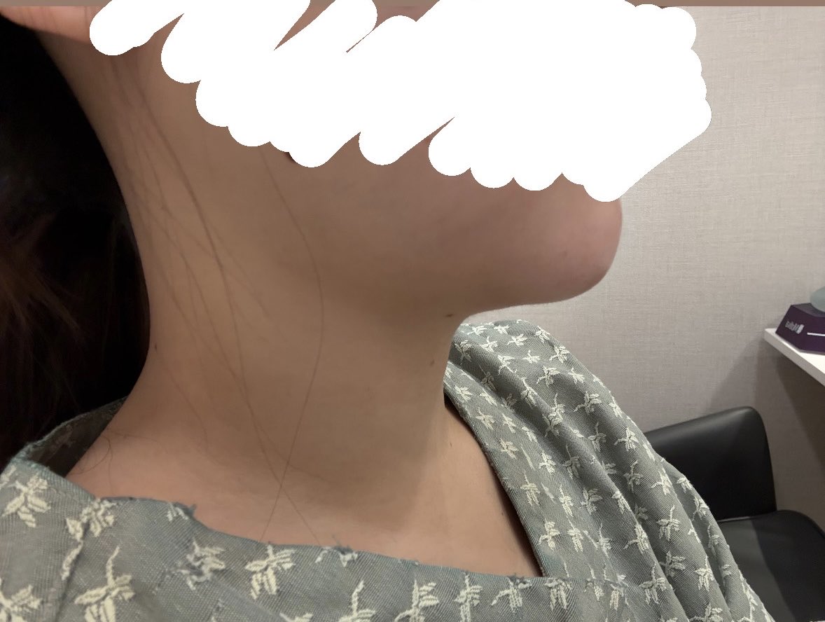 52i6CUH9Tn84939's tweet photo. @ilumipsjp
アイルミ整形外科のペリカン手術+唾液腺除去DT11日目です。
1枚目目before、2枚目目after
拘縮があり、顎下の凹凸が目立ちますが、かなりシュッとなったと思います。
拘縮後が楽しみです！ https://t.co/G1cyXYY5pq