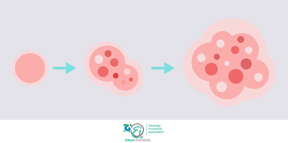EntrenaEII's tweet photo. La prevalencia de cáncer está aumentando en la población general. En la #EII existe un mayor riesgo de algunos tumores intestinales y extraintestinales, pero el seguimiento médico periódico y el control de la inflamación permiten detectarlos precozmente y mejorar el pronóstico. https://t.co/T7faYUuPWG