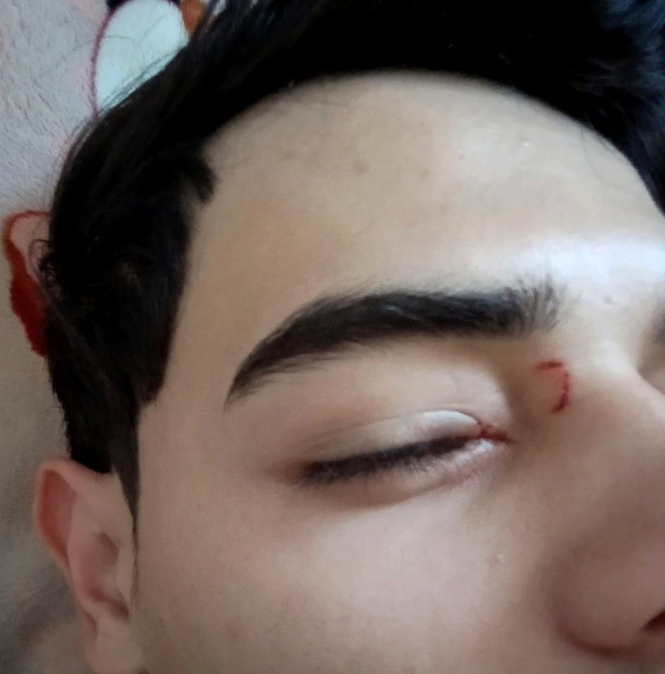 n_mohammedn's tweet photo. Please, just a moment… Do you think the suffering in Gaza has ended? I don’t think so.
I was injured in my eye while trying to break wood to prepare food for my family, yet no one cares about us.
How long will the world remain silent? Where is humanity? We are exhausted 💔 https://t.co/SbXwm7QluB