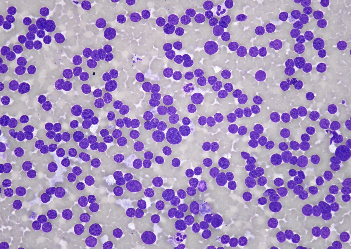 sza_jhcyto's tweet photo. CLASSIC "lymphocyte-like" naked nuclear morphology of an intrathyroidal parathyroid neoplasm on FNA. Needle rinse PTH levels were significantly elevated. (Thyroid, FNA) https://t.co/gLdVcvTl6Q