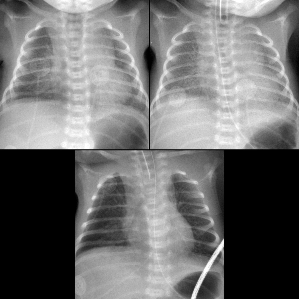 pedsimaging's tweet image. Premature newborn with respiratory distress

CXR AP obtained just after birth (above left) shows the lungs bilaterally to be relatively clear and hypoexpanded. 

#FOAMed #MedEd #FOAMRad #PedsRad #RadEd #radiology #pediatrics #NICU #Neonatology #radiologia #paediatrics #pediatria