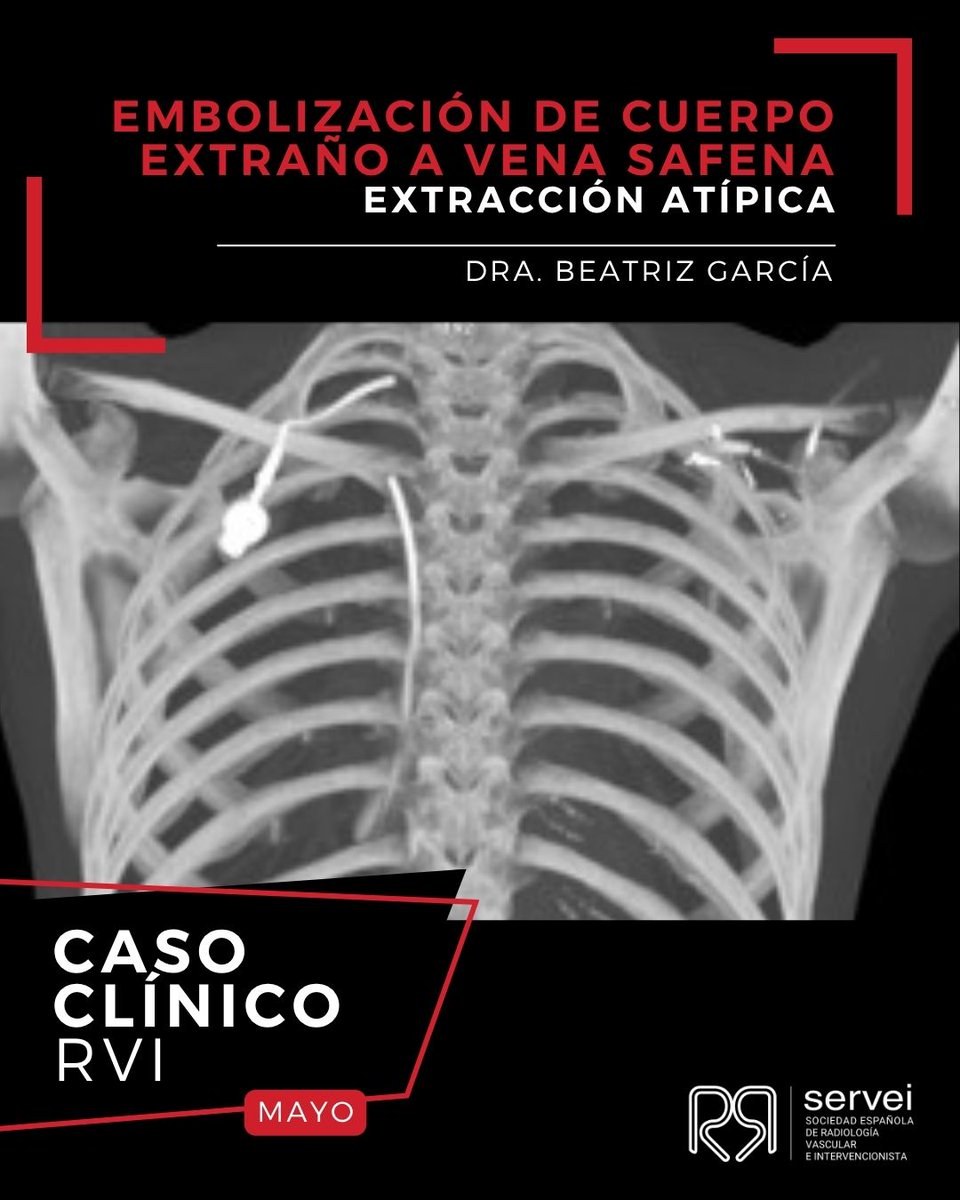SERVEISoc's tweet image. 🔍 Caso RVI del mes 

Un fragmento de reservorio roto… en la vena safena de la rodilla 😱

Migración atípica...¿qué hacer? 

💡Ingenio y destreza en #RadiologíaIntervencionista 

¡Gracias a los compañeros de @HUnivValdecilla por el caso!
👉 servei.org/embolizacion-d…

#RVI #IRad