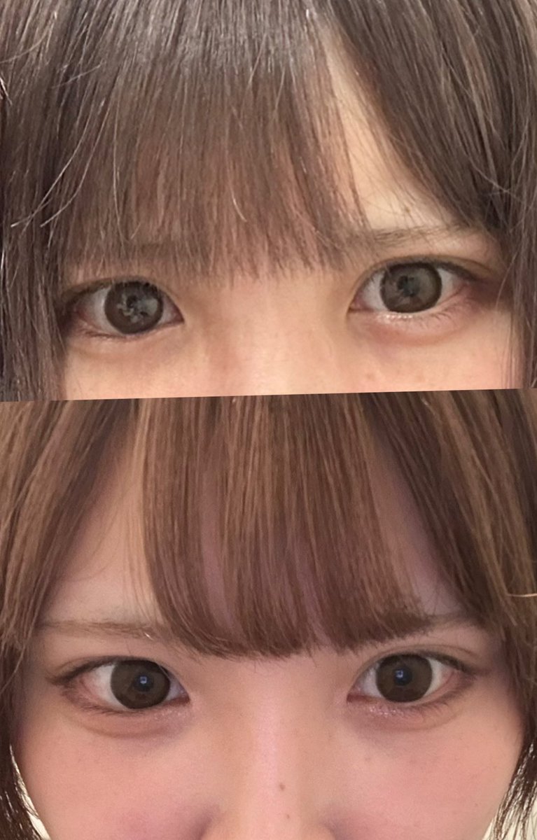zooczoczoc's tweet photo. 目頭切開でこの変化を出せる執刀医神すぎる😭😭😭😭😭
 #リドレープ法 #目頭切開 https://t.co/ngvj5HjCvU
