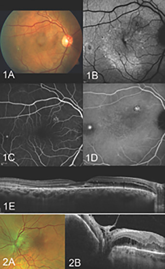 ophthopedia's tweet image. Ophthopedia Update: Corrigendum to Peripapillary Retinoschisis: The Expanded Spectrum and New Insights From Multimodal Imaging. Am J Ophthalmol. 2026;282:26-40. dlvr.it/TSMKzh #Ophthalmology #Ophthotwitter #Scicomm
