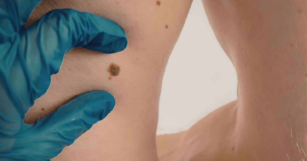 La prevenzione del melanoma: al via una campagna nei Coop fi. 

#melanoma #prevenzione #oncologia #coop 

Leggi l'articolo: medinews.it/comunicati/la-…