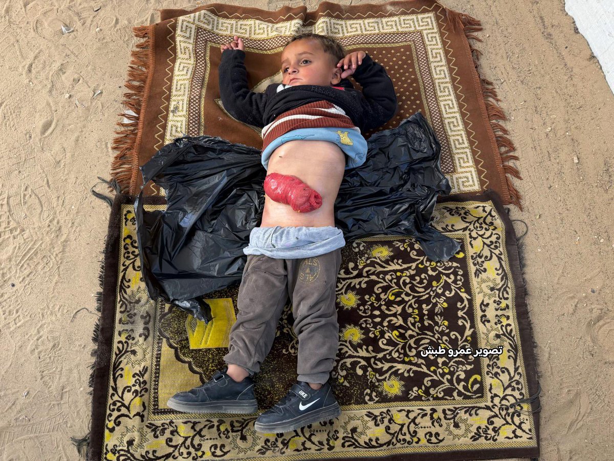 Three year old boy Zain abu Ismail is suffering severe conditions while he has no bed in the available hospitals in Gaza or any chance of treatment..
He’s in urgent need to travel for treatment abroad..