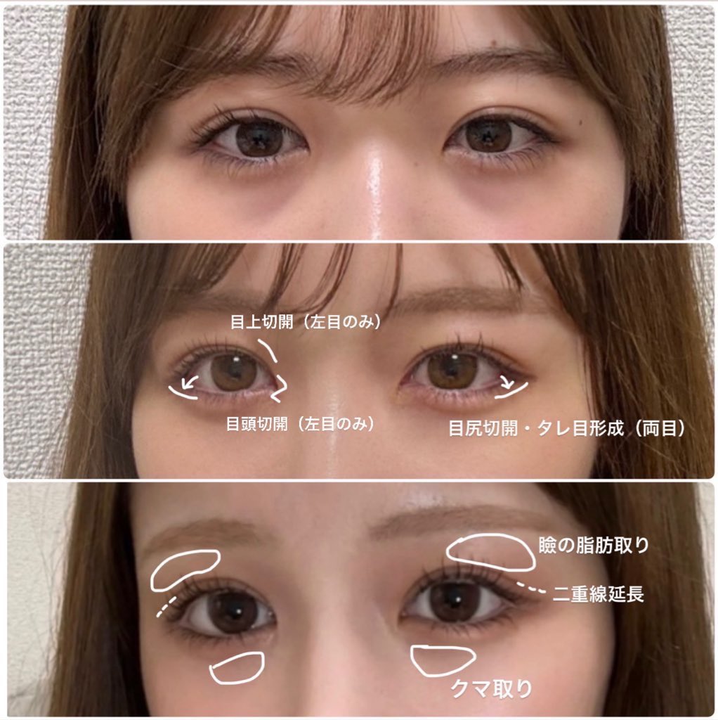 1965dile's tweet photo. 小粒目から脱却するためにやった施術・執刀医・注意点をまとめました✨くりくりな目になりたくて、やれることは全部やった。 https://t.co/PUAw7j3tBA