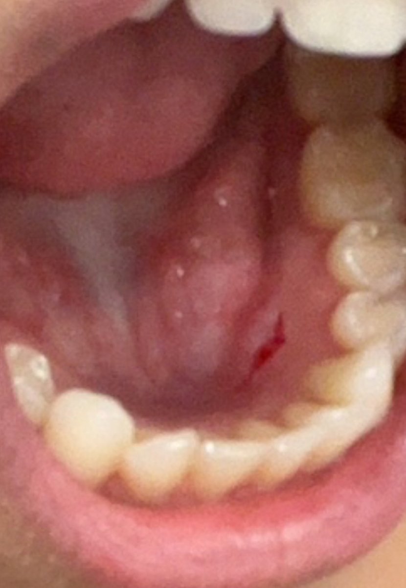 alexatherese216's tweet image. Welp it’s been over a week without a response from @jimmyjohns so I’m resorting to publicly posting the photos of the gash inside my mouth caused by a plastic tag in my sandwich on 4/23/26 #JimmyJohns #CustomerService #Help #Ouch