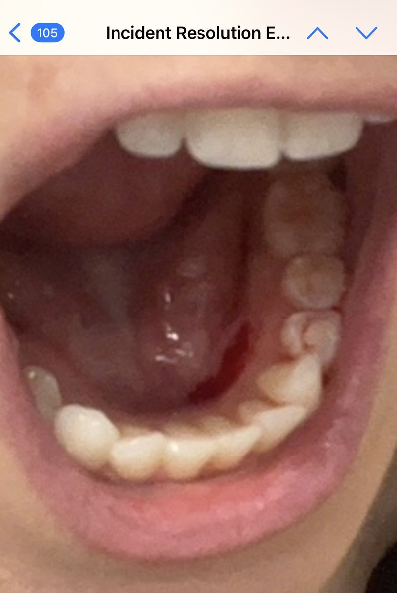 alexatherese216's tweet image. Welp it’s been over a week without a response from @jimmyjohns so I’m resorting to publicly posting the photos of the gash inside my mouth caused by a plastic tag in my sandwich on 4/23/26 #JimmyJohns #CustomerService #Help #Ouch