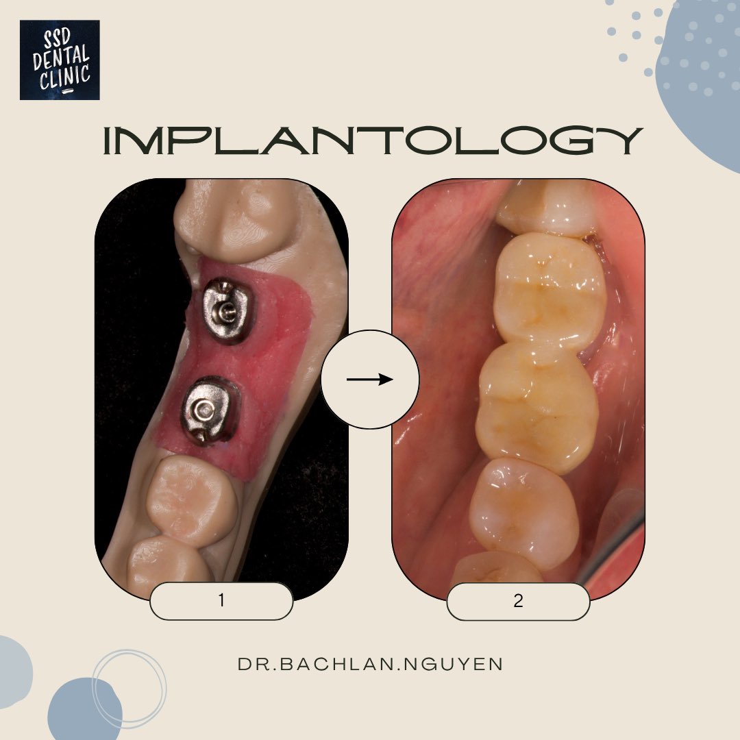 NhaKhoaSSD's tweet image. IMPLANTOLOGY 
 #implants #implantology #ceramics #crown
#ssddentalclinic