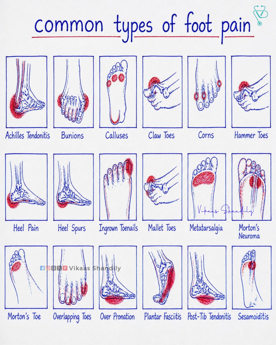 VikaasShandily's tweet image. Common Types of Foot Pain 
#FootPain #HealthAwareness #MedicalEducation #Physiotherapy #VikaasShandily