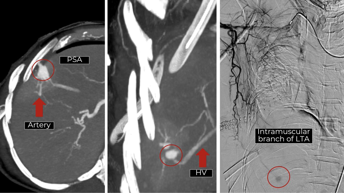 karananandpara's tweet photo. Case 158: with @BhaveshPopat7 @DrAntariksh @shubhamvanshi07 @DrHarshitVaidya 
.
“Direct Percutaneous Lateral Thoracic Artery Access for Embolization of an Iatrogenic Arterio-Hepatic Vein Fistula” .
Procedure details: https://t.co/1fspi1Mra3 https://t.co/4oIVCzIwcG