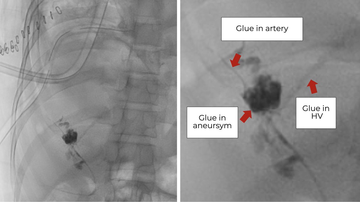 karananandpara's tweet photo. Case 158: with @BhaveshPopat7 @DrAntariksh @shubhamvanshi07 @DrHarshitVaidya 
.
“Direct Percutaneous Lateral Thoracic Artery Access for Embolization of an Iatrogenic Arterio-Hepatic Vein Fistula” .
Procedure details: https://t.co/1fspi1Mra3 https://t.co/4oIVCzIwcG