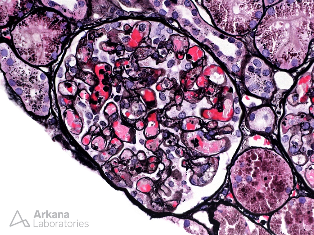 arkanalabs's tweet photo. An immunofluorescence panel for IgA, IgG, IgM, C3, C1q, kappa and lambda was negative. What is your diagnosis?
#DiagnoseThis #nephtwitter #pathtwitter #renal #kidneypath https://t.co/LryGfEc1CC