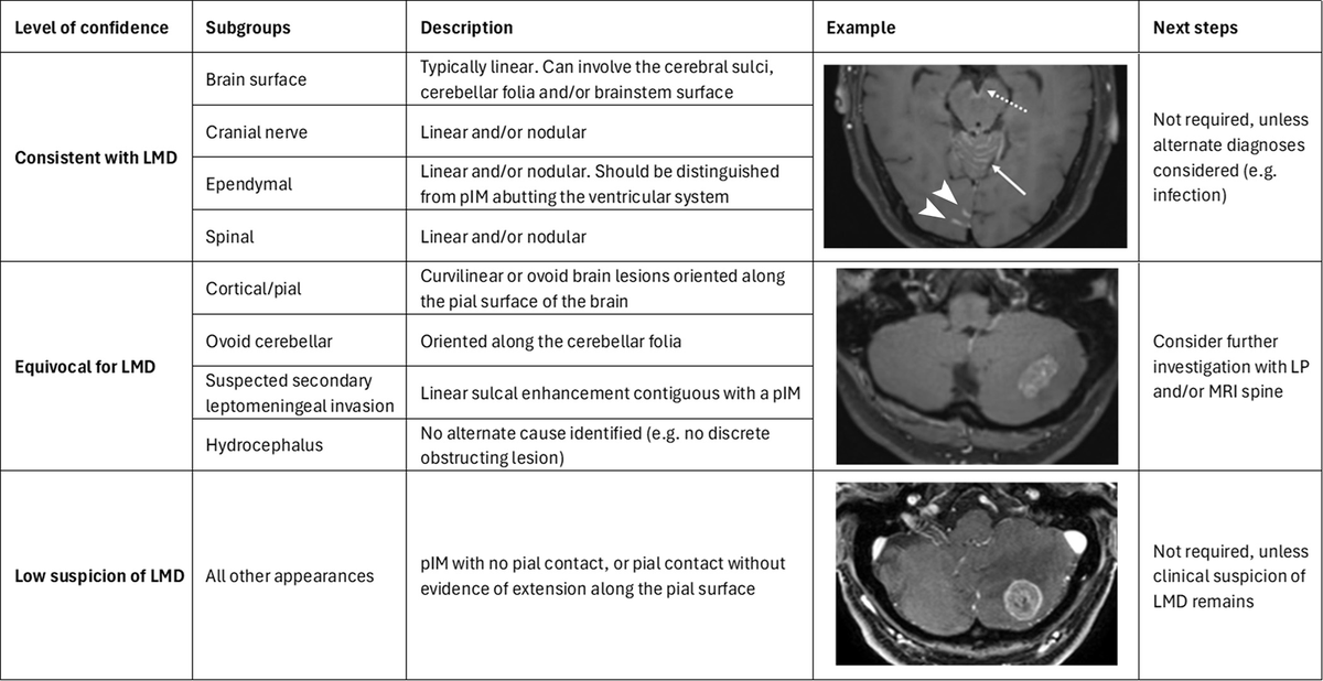 DocNavarrow's tweet photo. 🧠MRI patterns can stratify suspicion for leptomeningeal metastatic disease (LMD):

▪️Consistent (linear/nodular leptomeningeal enhancement)
▪️Equivocal (pial-oriented lesions, unexplained hydrocephalus)
▪️Low suspicion

https://t.co/qPpUBaWRUN https://t.co/6FnqdKEsOP