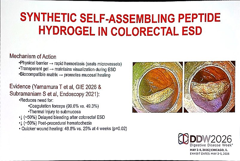 KralJan's tweet image. Synthetic self-assembling peptide hydrogel in colorectal ESD = 💥 game changer❓
✅ Rapid hemostasis
👁️ Maintains visualization
🩹 Faster healing (48.8% vs 25%)
⬇️ Less delayed bleeding &amp;amp; thermal injury

#Endoscopy #MedEd #ddw2026 @DDWMeeting @ASGEendoscopy @ESGE_news