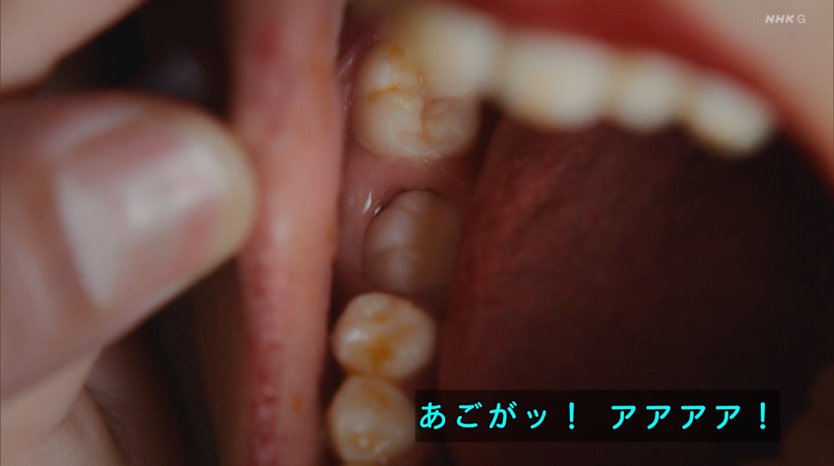 …あの人達
助けられたけどこれから一生舌が無い生活を送ることになるんだよな。
ジョルノや仗助もいないし…
　
と、思った後で
ワンチャン、その足でフランス料理食いに行けば生えるのでは？
と思い始めた自分がいる
#岸辺露伴は動かない
#泉京香は黙らない