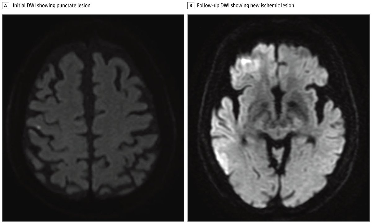 JAMANeuro's tweet image. Delayed onset of hemichorea and dystonia can occur after cortical temporal #Stroke, even when imaging reveals small acute ischemic lesions and routine blood tests are normal. ja.ma/42O1GSV