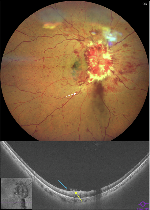 ophthopedia's tweet image. Ophthopedia Update: Optic nerve metastasis with secondary combined central retinal artery and vein occlusion from small cell lung cancer dlvr.it/TSMmgF #Ophthalmology #Eye #Ophthotwitter