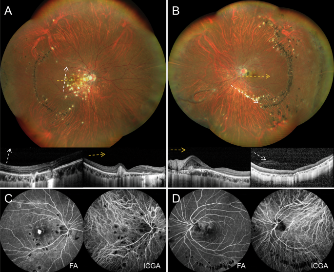 ophthopedia's tweet image. Ophthopedia Update: Bilateral streaky multifocal choroiditis dlvr.it/TSMmYx #Ophthalmology #Eye #Ophthotwitter