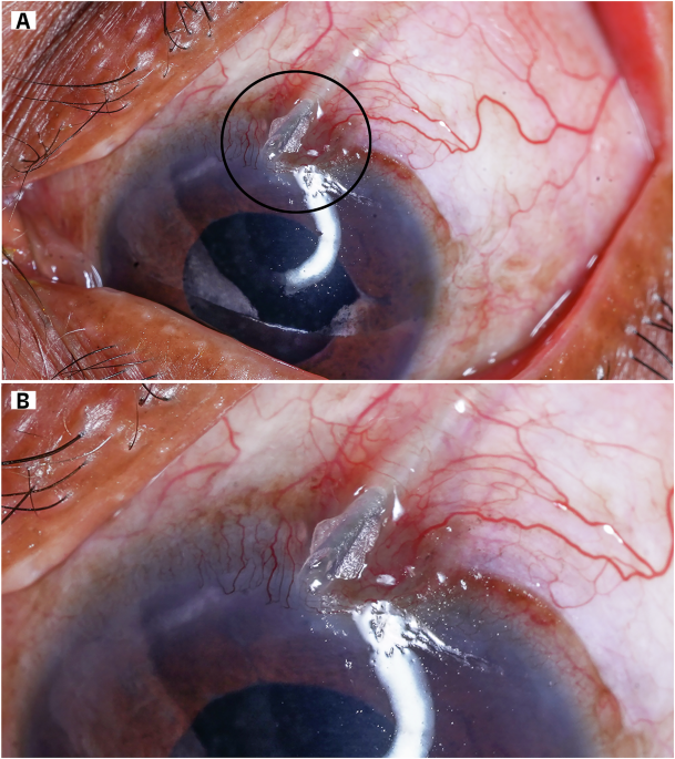 ophthopedia's tweet image. Ophthopedia Update: Posterior plate migration with tube retraction and exposure dlvr.it/TSMmmH #Ophthalmology #Eye #Ophthotwitter