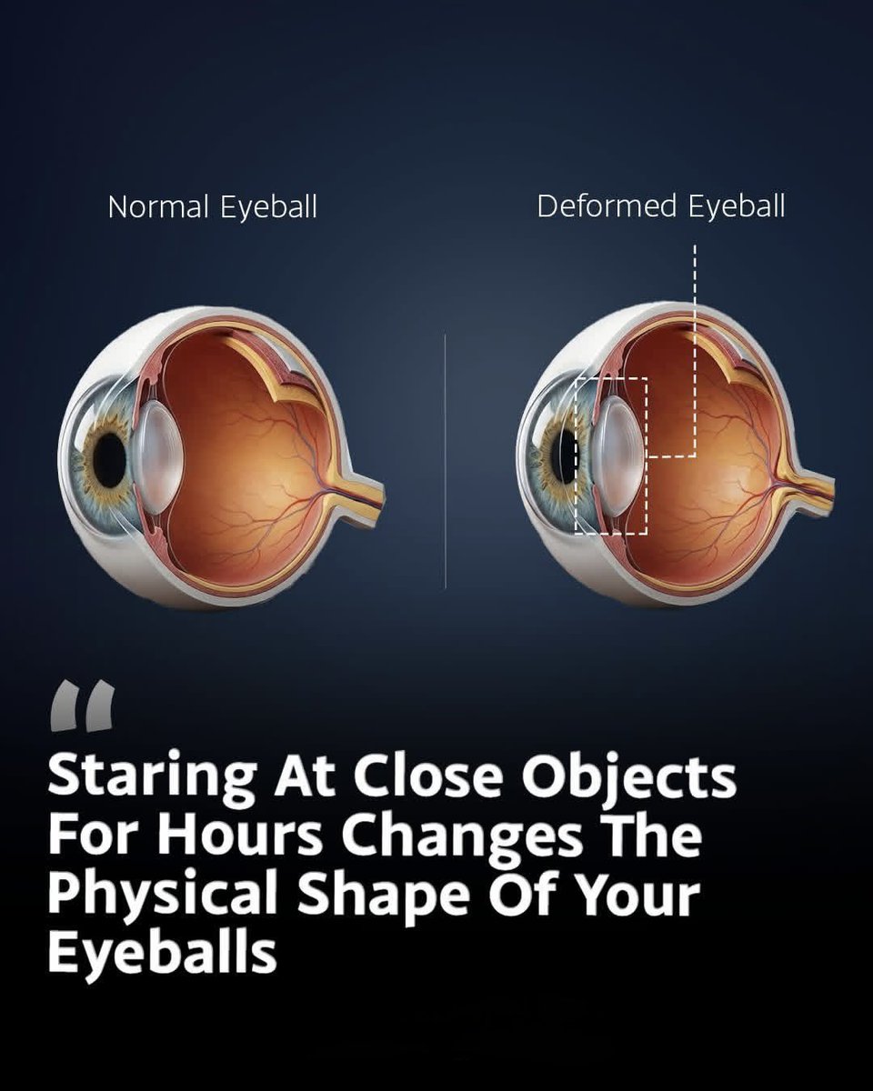 scitechgirl's tweet photo. 🚨 YOUR EYES ARE QUIETLY CHANGING…

Staring at close objects for hours—phones, books, screens—can slowly change the shape of your eyeballs. Over time, the eye can grow slightly longer, making distant things look blurry. This is how nearsightedness develops… silently.
It’s not instant. It happens little by little, without you noticing.
Take breaks. Look far away. Your eyes need it.

Source: American Academy of Ophthalmology. Myopia (Nearsightedness).