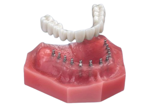 gzirakiandmd's tweet image. Affordable implant dentures are within reach thanks to mini dental implants. Contact East Longmeadow Family Dental Center to learn more. #eastlongmeadow #dentist bit.ly/3SrTR0v