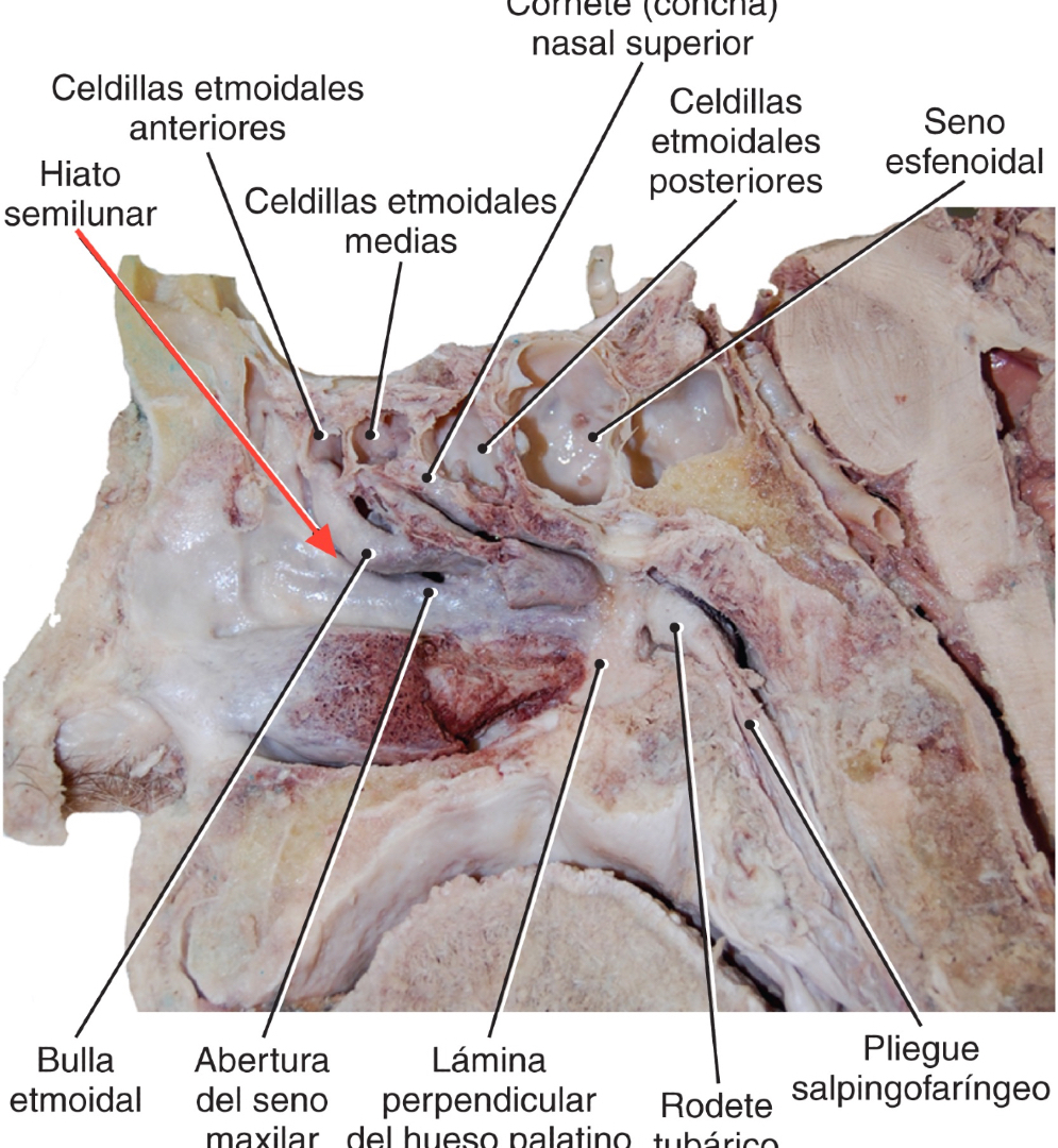 PasionAnatomia's tweet photo. El #HiatoSemilunar es un surco semicircular largo, en el que drena el conducto frontonasal (drenaje del #Seno Frontal a través del infundíbulo), así como las #CeldillasEtmoidales anteriores. 
📚Gray. Guía de disección del cuerpo humano © 2019. https://t.co/CGLXZj7Z9D
