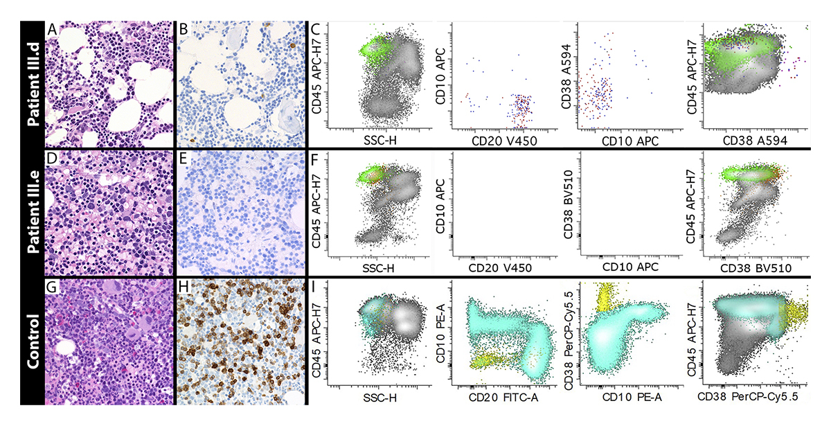 jhumimmunity's tweet photo. Lauren M. Gunderman, Eric J. Allenspach et al. share the second report of X-linked SEPTIN6-related disease in two brothers identified by #SCID newborn screening. https://t.co/SReYajdYAM

#Septins #IEI #InbornErrorsofImmunity #ClinicalPhenotypes #Bcells https://t.co/ktruD8xOVD