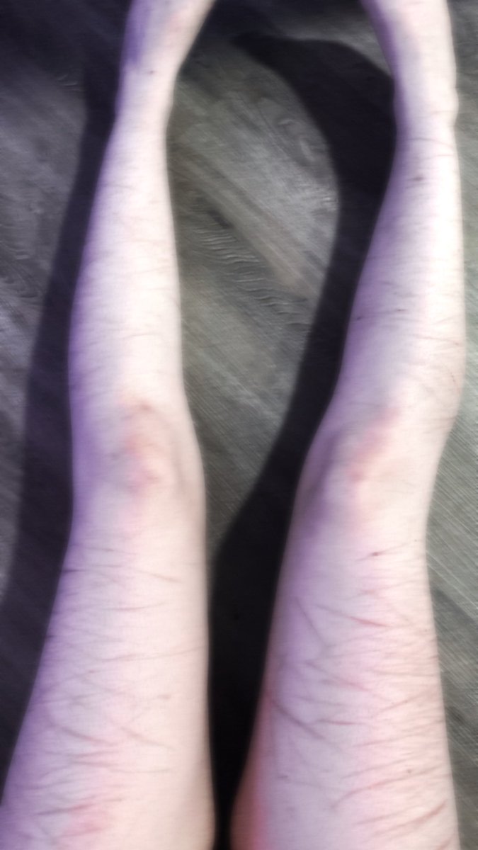 blade352337's tweet photo. these are my legs rn
i wish i had better pasty filters that didnt erase all mine and my boyfriend 
and everyones collective work on my legs lmao
#slitwt #shtwt #sh #scars #slittwt https://t.co/snTKwxknnG