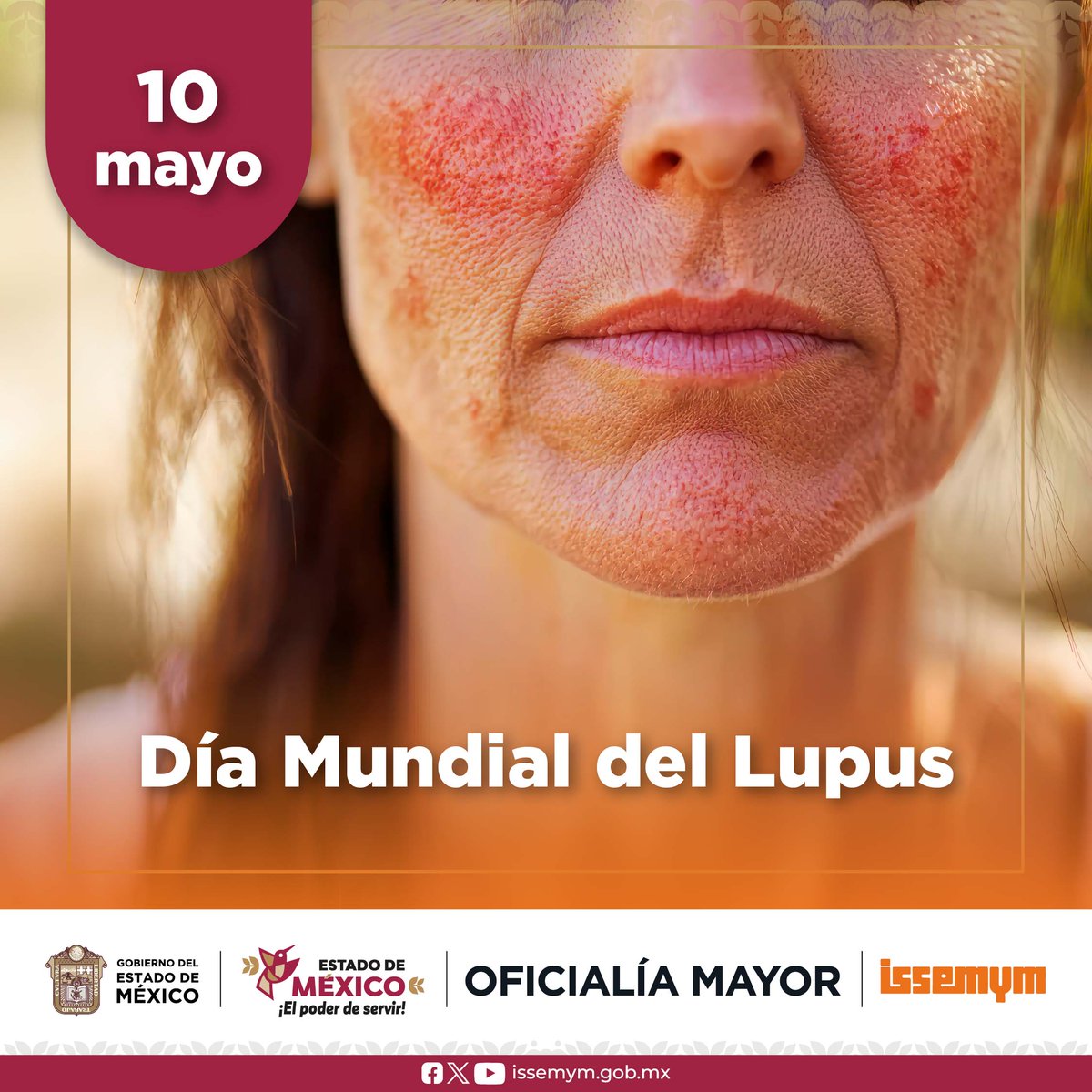 Issemym's tweet photo. El lupus es una enfermedad autoinmune que puede afectar diferentes órganos del cuerpo.

El diagnóstico y tratamiento oportunos ayudan a mejorar la calidad de vida.

#DíaMundialDelLupus #EquipoIssemym #ElPoderDeServir https://t.co/7S7qPQChMC