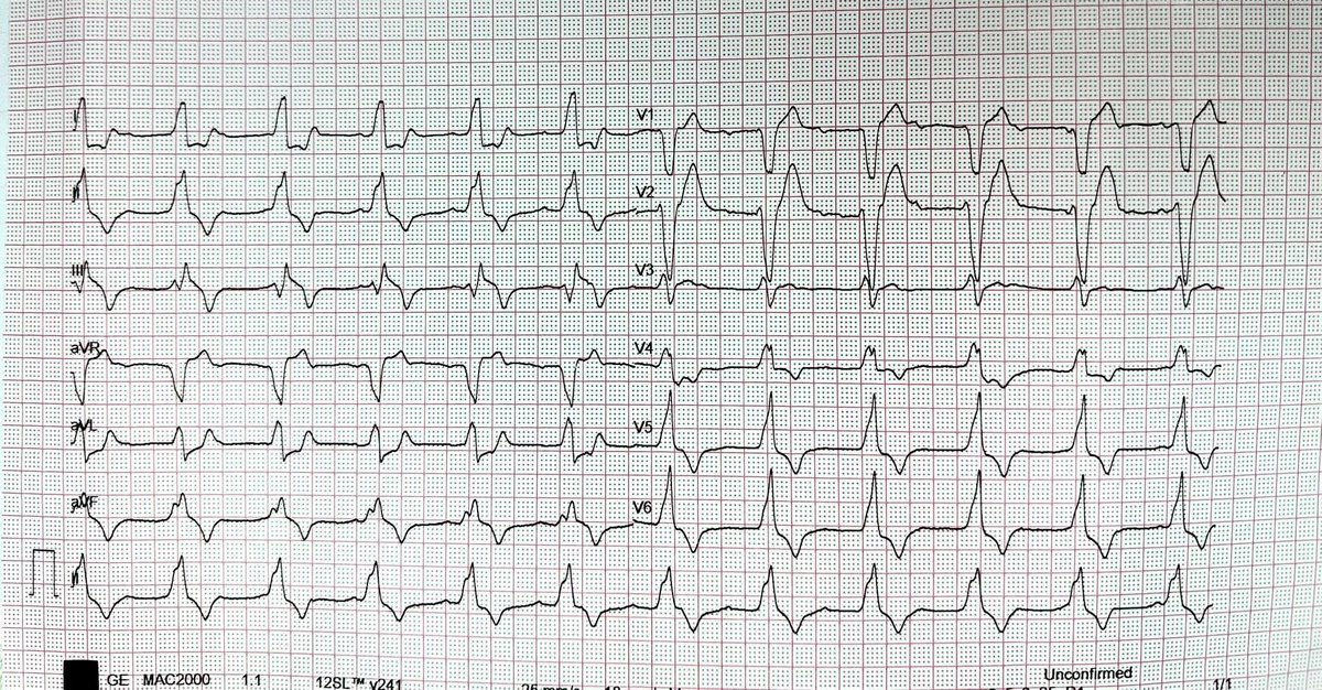 albertoortegana's tweet image. What’s the ECG diagnosis? 
Patient presented with chest pain and Shortness of breath. 

#heartfailure #ekg #ecgchallenge #heartattack #HeartFailureAwareness #MedTwitter #MedX #FOAMed @drobiy12