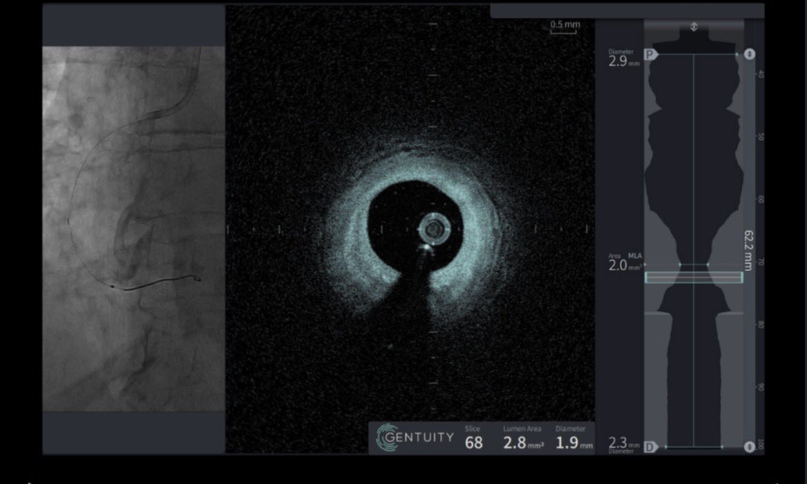 DrPaulRees's tweet photo. Great to have next-generation HFOCT on the menu at @UMN_DCVM - and thanks to @gentuity for bringing us their new #OCT Vis-Rx Prime device https://t.co/VUVlUsPZu1