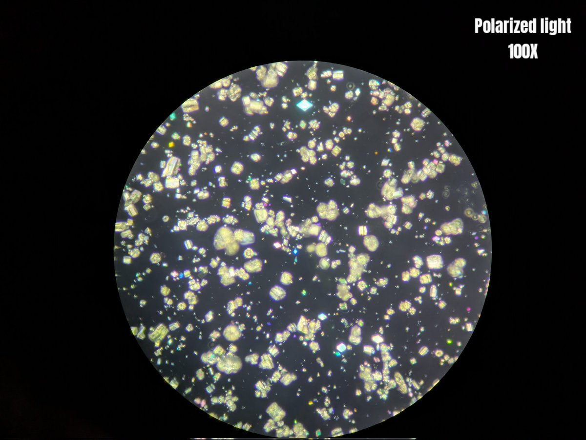 neph_ag's tweet photo. #UrinarySediment 
Patient with severe amount of uric acid crystals in #UrineMicroscopy https://t.co/4zwbTZyGF7