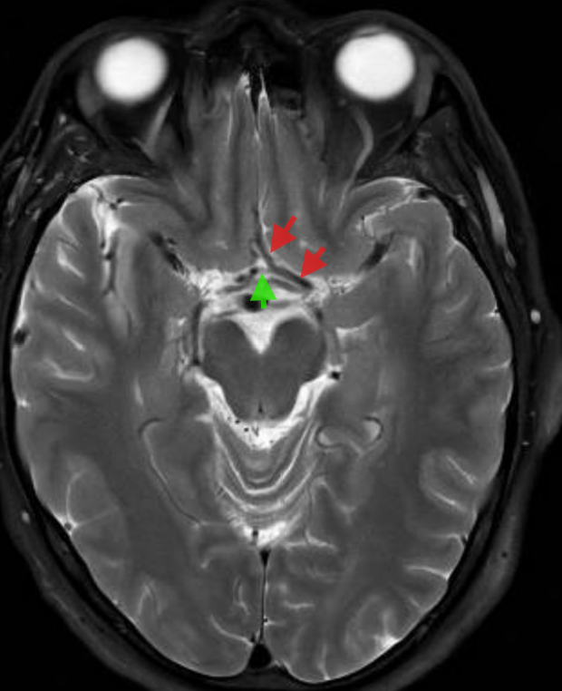 Beautiful picture of the optic chiasm. What inflammatory/demyelinating ...